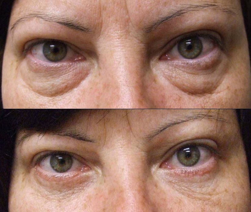Need to Find Out About Blepharoplasty Santa Barbara post thumbnail image